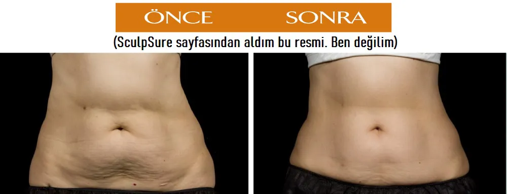 SculpSure Ameliyatsız Lazer Lipoliz